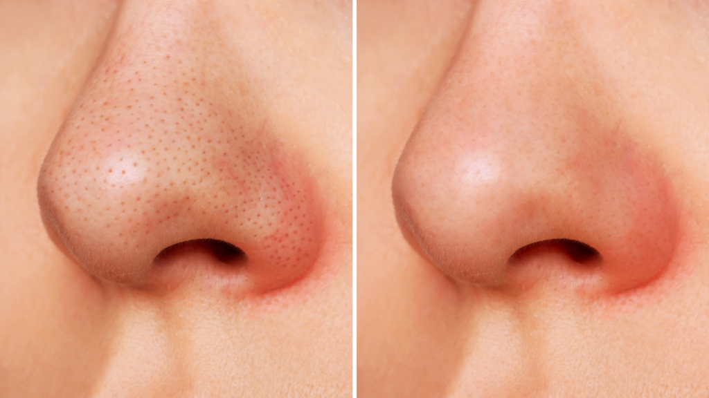 IRRITATED AND DRY NOSE CONTOUR SKIN YSLAB