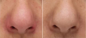 Irritated and dry skin nose contour