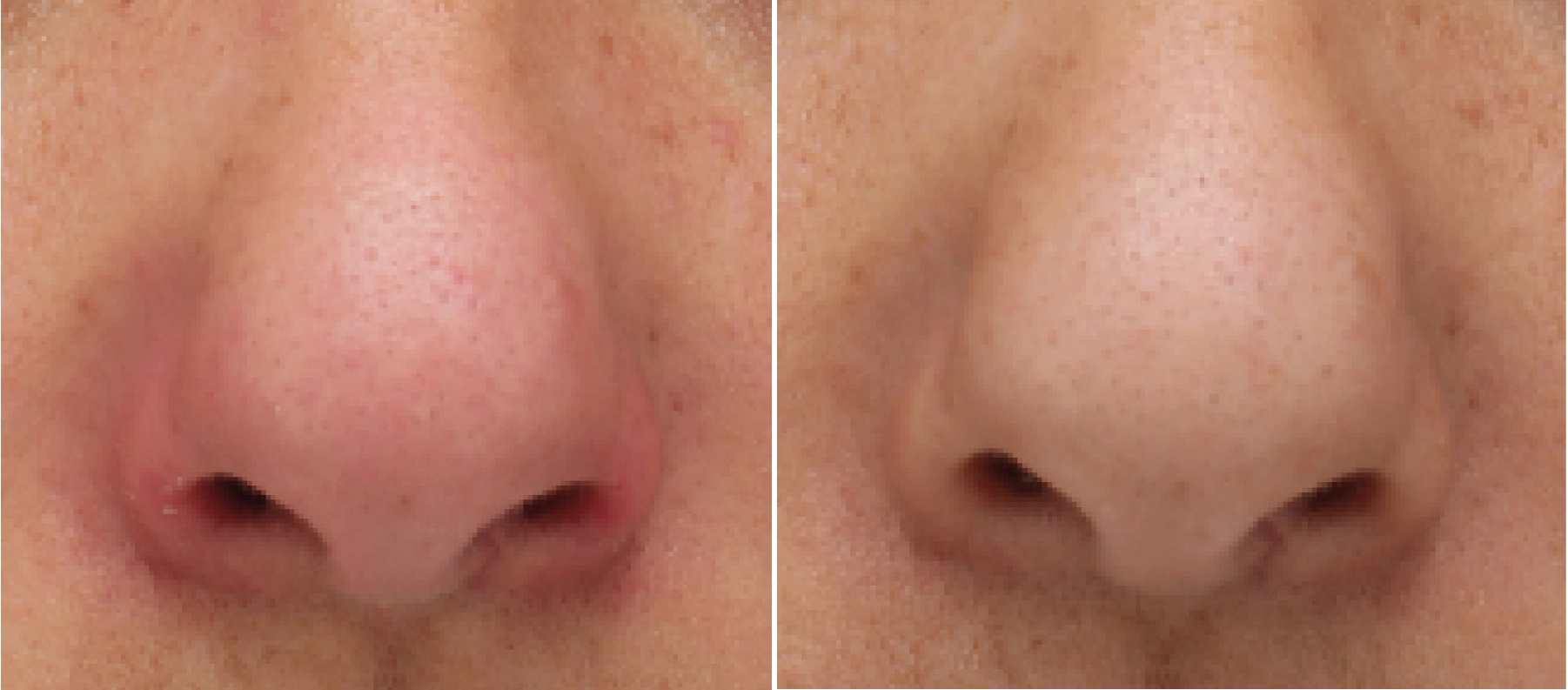 Contour du nez irrit, sec : ce qu'il faut savoir - YSLAB Contour du nez irrit, sec : ce qu'il faut savoir - YSLAB